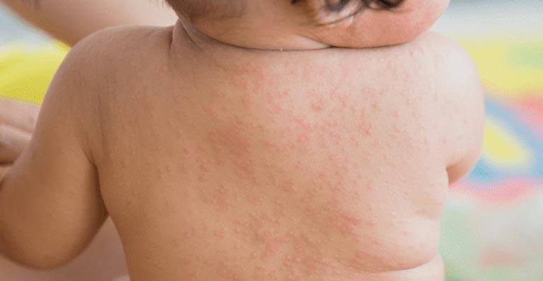 楊浩康(Yeung Ho Hong)醫生講解嬰兒玫瑰疹