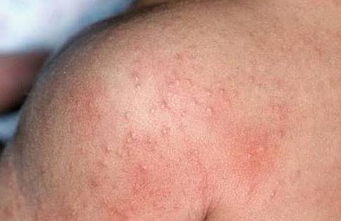 楊浩康(Yeung Ho Hong)醫生講解熱痱 (Heat Rash/Prickly Heat)