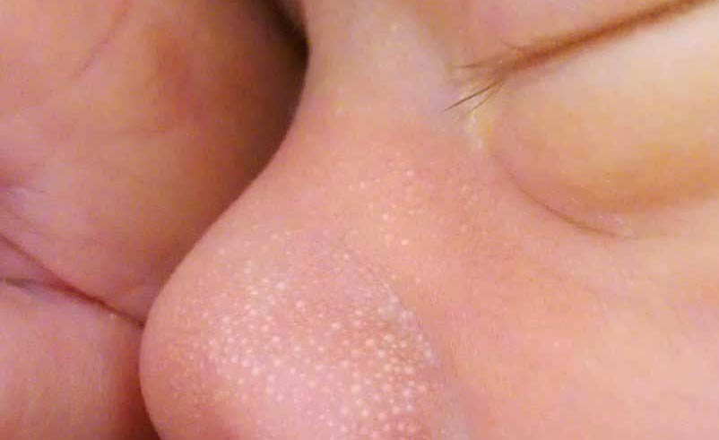 楊浩康(Yeung Ho Hong)醫生講解嬰兒粟粒疹 (Milia)