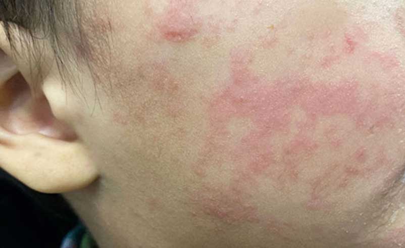 楊浩康(Yeung Ho Hong)醫生講解麻疹